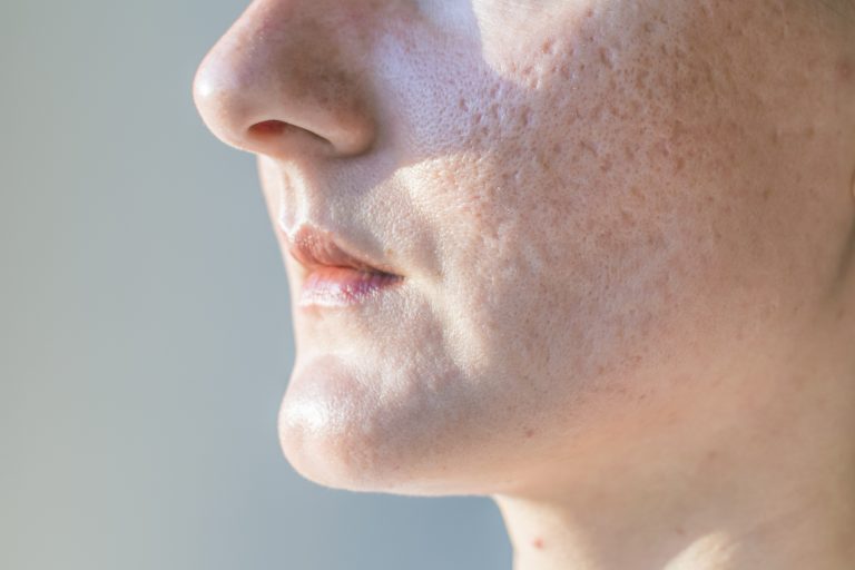 Atrophic scarring - dermal filler - london real skin