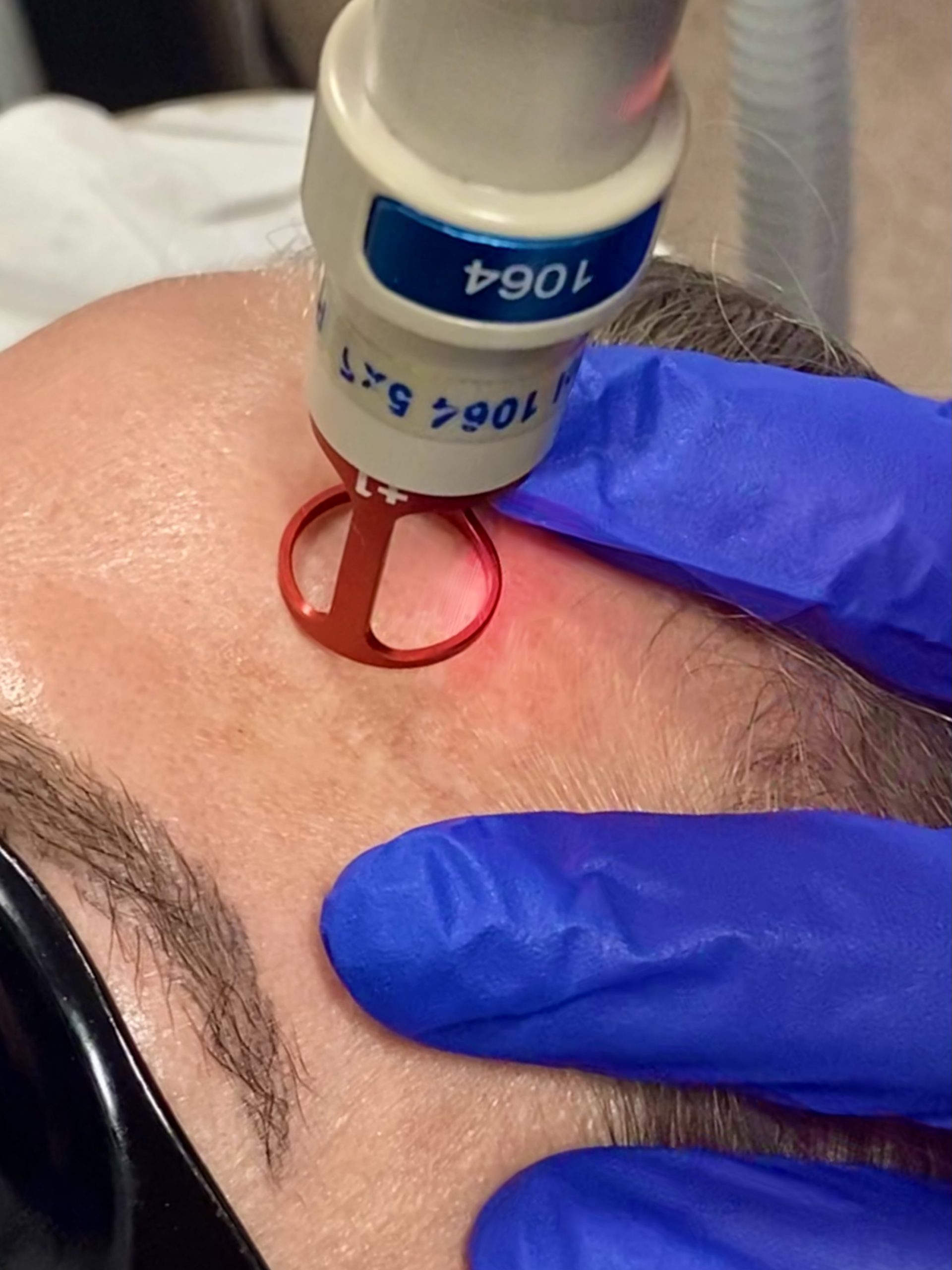 pigmentation treatment London