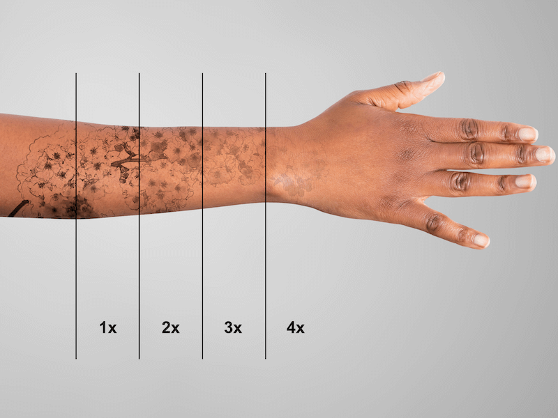 Laser Tattoo removal in London