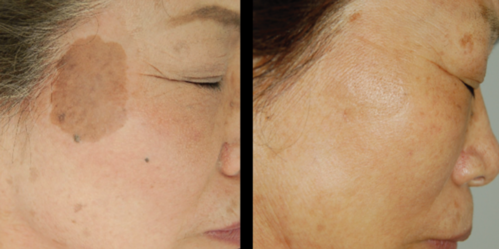 London real skin BBL Hero treatment