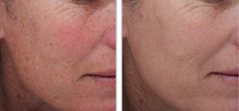 BBL Moxi laser treatment at London real skin in holborn