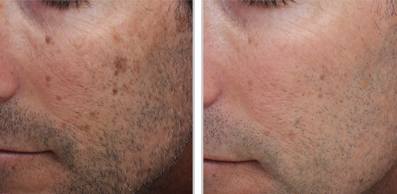 laser treatment for men in Holborn