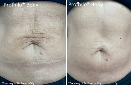 stomach tightening treatment in Holborn