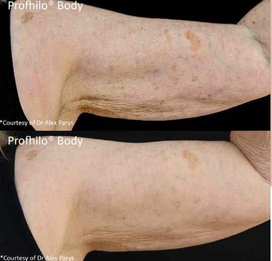 profhilo body holborn london