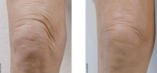 improve sagging skin on knees london real skin holborn