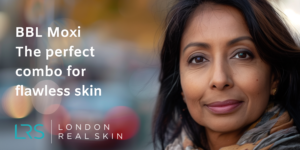 BBL Moxi treatment Holborn London