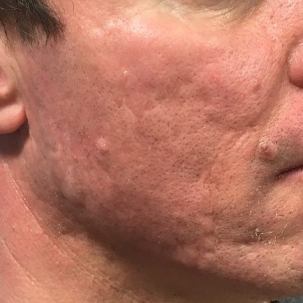 Acne Scar Treatment - After sq