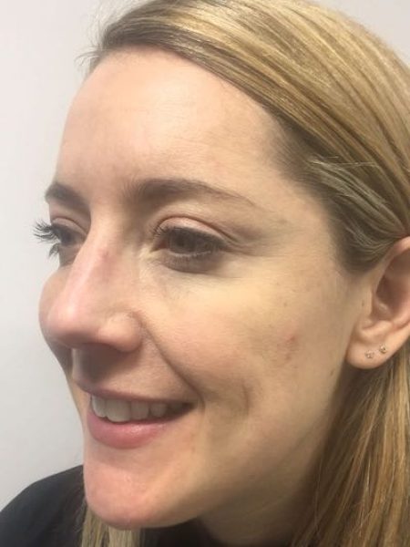 Botox Female - After 400