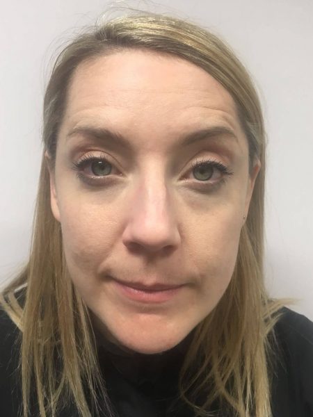 Botox Forehead After[1] copy