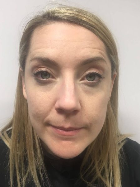 Botox Forehead After[1] copy
