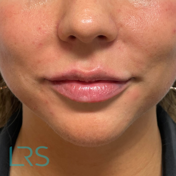 LIP FILLER LONDON REAL SKIN - AFTER