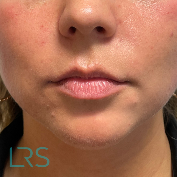 LIP FILLER LONDON REAL SKIN - BEFORE