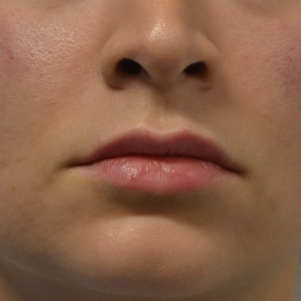 Lips After sq