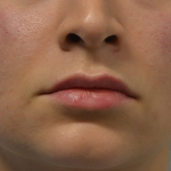 Lips After sq