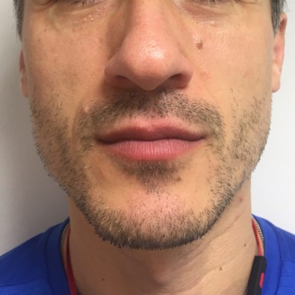 Male Lip Enhancement - After sq