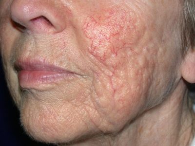 Thread Veins Face - Before crop