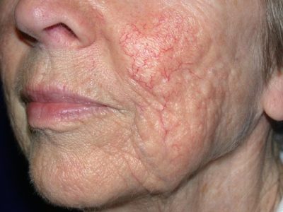 Thread Veins Face - Before crop