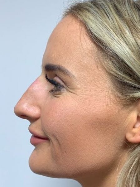 rhinoplasty after 43